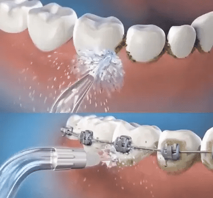🦷💧 HydroSmile™ – Irrigador Oral Recargable con Boquillas Intercambiables